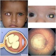 الريتنوبلاستوما(Retinoblastoma) هو ورم سرطاني يصيب شبكية العين و يعد من أكثر أنواع أورام العين شيوعا لدى الأطفال .الريتنوبلاستوما نوعان : نوع غير وراثي ويشمل معظم الحالات و نوع وراثي وهو أقل شيوعا وعاده ما يصيب العينين معاً – أعراضه*الحدقه البيضاء: من اكثر الأعراض شيوعاً و يتلّخص بظهور لون أبيض وسط البؤبؤ عندما يوجّه إليها أي إشعاع ضوئي، وأحياناُ يعبر عنه الناس باسم(عين القط) يظهر بوضوح عند التقاط الصور. *الحول: إذا كان دائماً في عين واحده أو العينتين معاً فيدل على إصابة مركز الرؤية. هذه الأعراض يجب أن تراقب من خلال الأهل وعند ملاحظة إحدى العلامات يجب عرض الطفل على أخصائي العيون فورا مع العلم انه ليس كل حالات الحول سببها الرتنوبلاستوما. يعتمد تشخيص المرض على فحص قاع العين بعد توسيع الحدقه  و يحدد من خلال الفحص حجم الورم و عدده ومدى انتشاره مع إجراء بعض الفحوصات مثل الموجات الصوتية والتصوير المغناطيسي (MRI ) للتأكد من عدم إنتشار الورم خارج العين وإصابة الجهاز العصبي علاج هذا النوع من السرطان ممكن خاصة إذا تم اكتشافه في مرحلة مبكرة وتكون نتيجة العلاج جيدة بنسبة 90%هدف العلاج هو شفاء الطفل مع الحفاظ قدر المستطاع على عينه وبصره.أما طرق العلاج فتحدد حسب نوع الورم حجمه ومدى انتشاره.دور الأهل في تقبل التشخيص و المسارعه في العلاج مهم جدا للحفاظ على حياه الطفلد. البراء القاسميإستشاري طب و جراحة العيون@dr_albaraa#صحة_عينيك #طفولة #عيون #أطفال #حول #الرياض #جدة #السعودية #ورم
